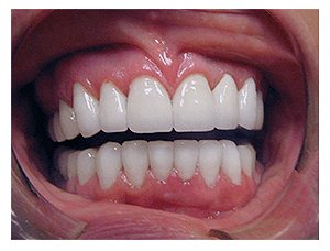 Smile makeover, after