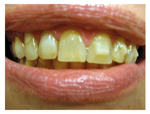 Smile makeover, before