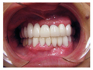 Smile makeover, after