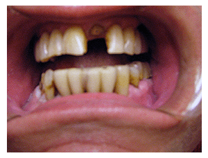 Smile makeover, before