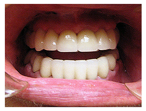 Smile makeover, after