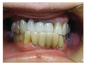 Smile makeover, before