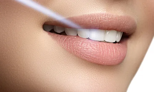 Close-up of a smile with a thin dental laser beam aimed at the teeth